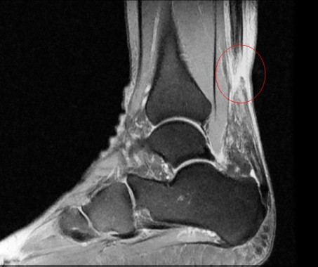 Röntgenbild Oberessprunggelenk von der Seite, Achillessehnenriss im roten Kreis