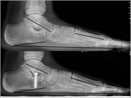 Röntgenbild eines kindlichen Knicksenkfußes: Vor Operation und nach Talus stopp Arthrorise
