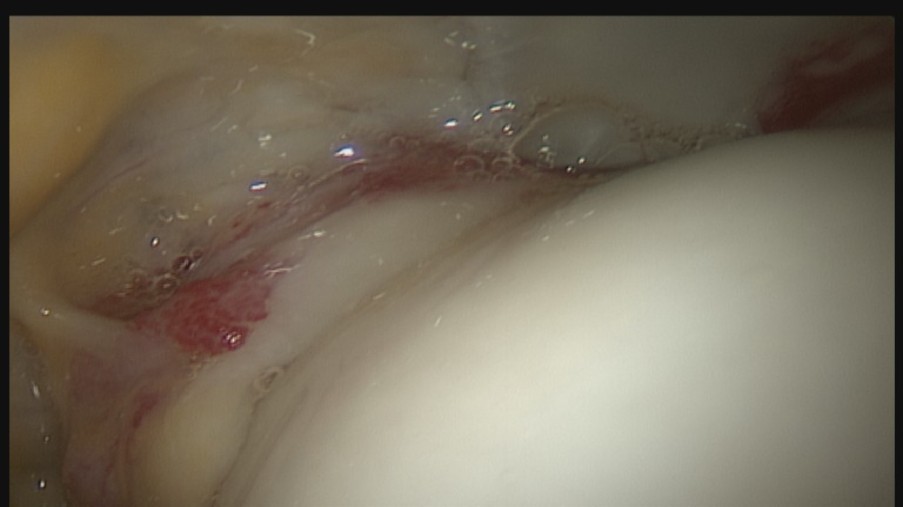 Blick ins Hüftgelenk. Auf der rechten Seite sieht man den Hüftkopf mit Knorpel