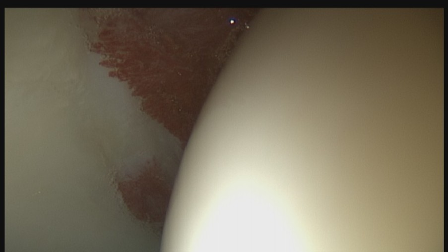 Blick ins Hüftgelenk mit Gelenkinnenhautentzündung links: Gelenkpfanne , rechts Hüftkopf