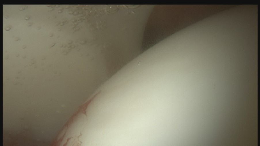 Hüftgelenk mit Gelenkpfanne, Gelenklippe und Hüftkopf