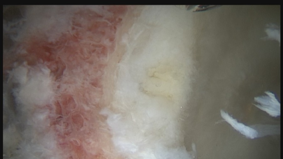 Gelenkpfannenach dem das Pincer abgetragen ist. An den Stellen an denen kein Pincer mehr istkommt das rot der Gelenkpfanne durch