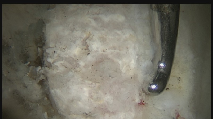 Pincer-Osteophyt hier weiß mit einem L-förmig gebogenen Instrument (Tasthaken)