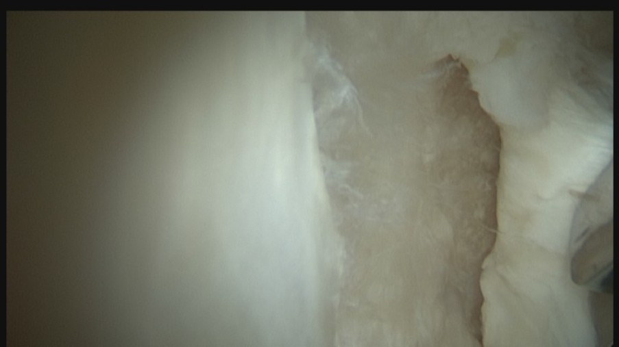 Arthroskopische Sicht einer groben Knorpelschädigung der Hüftgelenkspfanne