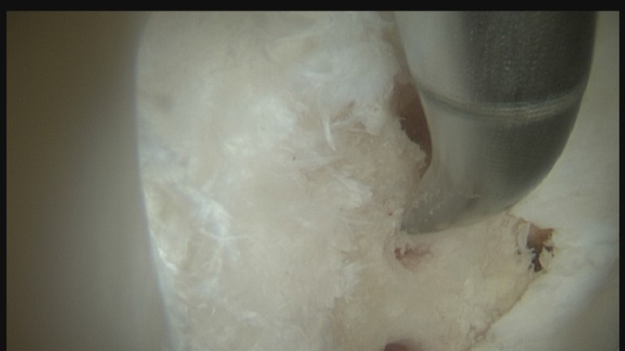Hell- bis dunkelgrauer Hintergrund, Knochen mit einer weissen faserigen Schicht (Knorpel). In dem Bereich wo diese Schicht fehlt mehrere Löcher. Rechts auf dem Bild von oben bis in die Mitte eine Mikrofakturierungsahle. Dies ist ein abgewinkeltes OP Instrument das es in verschiedenen Winkel gibt um die Mikrofakturierung in den Knochen zu schlagen.
