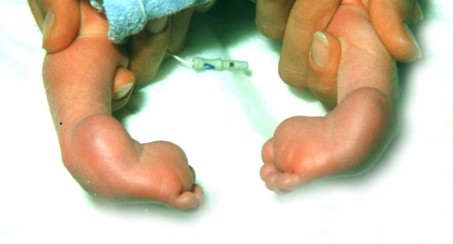 Kleinkind mit nach innenstehenden Füßen
